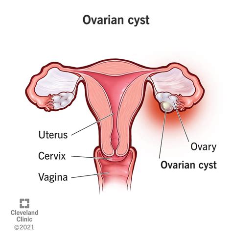 Ovarian Cysts Causes Symptoms Diagnosis Treatment