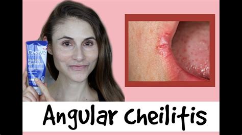 Angular Cheilitis Causes And Treatments A Qanda With Dermatologist Dr Dray Youtube