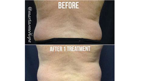 Sculpsure View Images Before And After Treatment