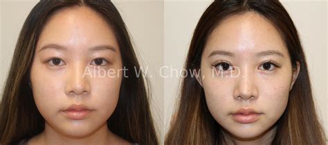 Asian Rhinoplasty Before And After