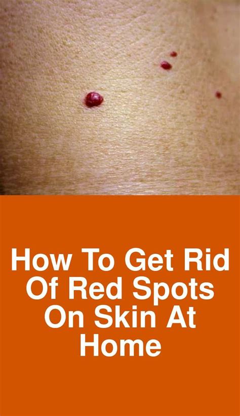 How To Get Rid Of Red Spots On Skin At Home Red Spots On Skin Causes