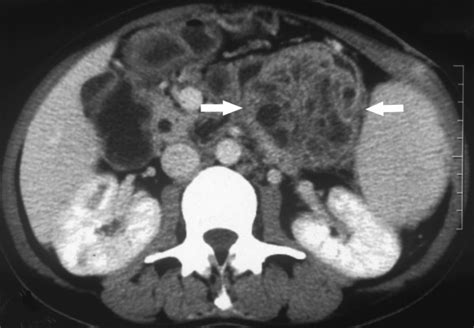 Abdominal Ct Scan The Tumor Showing A Heterogeneous Multiloculated