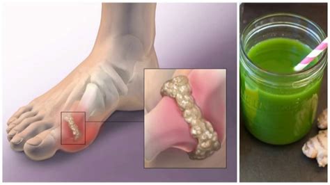 How To Naturally Get Rid Of Uric Acid Crystals In The Joints Youtube