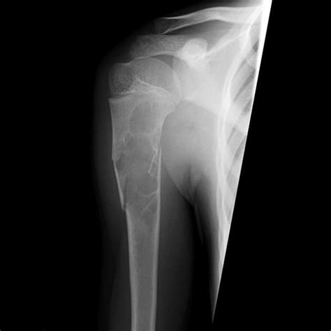 Unicameral Bone Cyst Radiology Reference Article