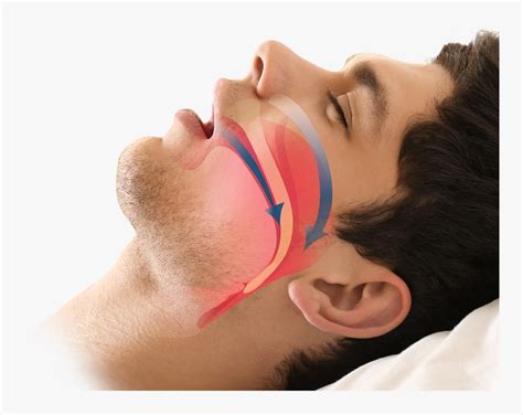 Obstructive Sleep Apnea OSA Treatment Options CPAP