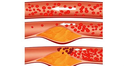 Clean Your Clogged Arteries And Eliminate Bad Cholesterol With This