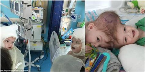 Conjoined Twins Finally Separated After A Successful Surgery Photos