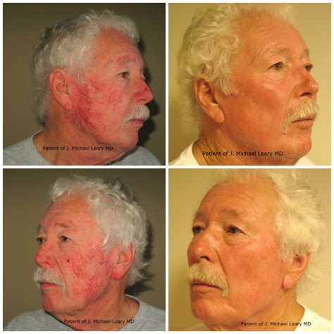 Facial Vein Treatment Orange County Newport Beach