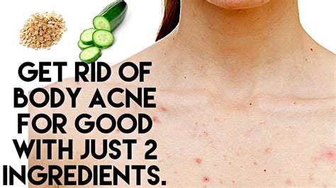 How To Get Rid Of Body Acne Using All Natural Products