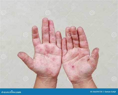 Hfmd Rash And Red Blisters On The Body Of A Child Stock Photo Image