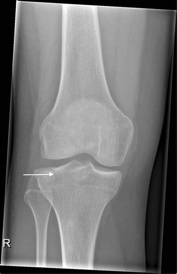 Anteroposterior X Ray View Of A Tibial Plateau Fracture Schatzker Ii