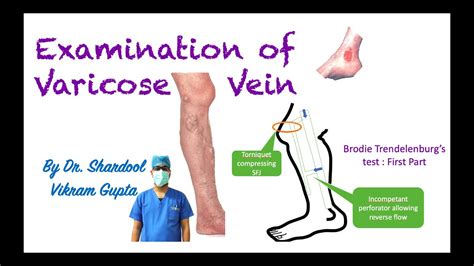 Examination Of Varicose Vein For Mbbs Ms Surgery Medical Students