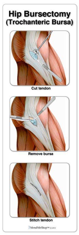 Hip flexor tendonitis is a different but related condition, which also leads to hip pain. hip bursectomy, trochanteric bursa #mendmyhip #mendmeshop ...
