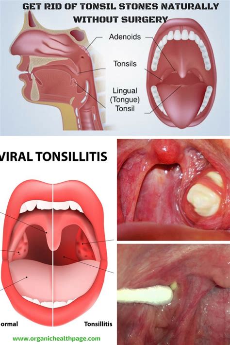 Hypothyroidism solution's 4 week plan is completely reversing all hypothyroidism symptoms. Science Media Guru: How To Dislodge Food Stuck In Esophagus
