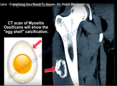 Myositis Ossificans —