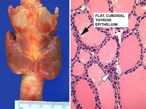 Pathology Of Thyroid And Parathyroid Russell Flashcards Quizlet