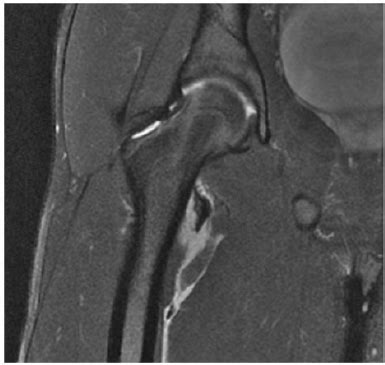The position of the lesser trochanter close to the head of the femur is one of the defining characteristics of the prozostrodontia. MRI scan showing an avulsion of the right lesser ...