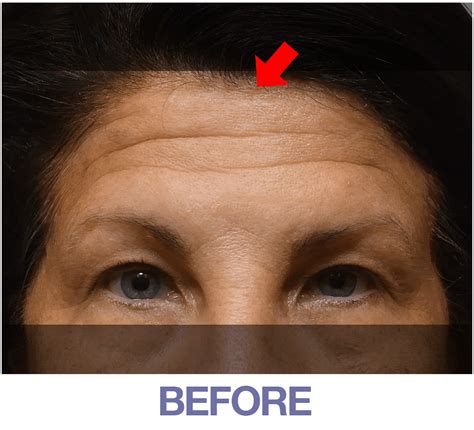 Home Official Store Of Plexaderm Skincare Instantly Remove Wrinkles