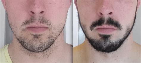I used minoxidil for roughly 2 years to grow my beard and while i never personally experience any dramatic scalp shedding, my beard did go. How Long Does Minoxidil Take To Work For Beards - iManscape