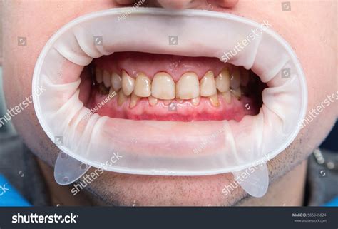 Dental Fluorosis Termed Mottled Enamel Hypomineralization Stock Photo