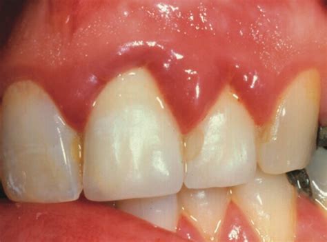 Gingivitis Causes Symptoms Treatments Hyperplasia Pictures Health9