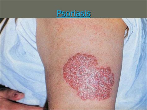 Psoriasis Classification Of Psoriasis презентация онлайн