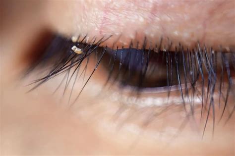 Itching And Redness In Eyes Can Be The Symptoms Of Eyelash Lice