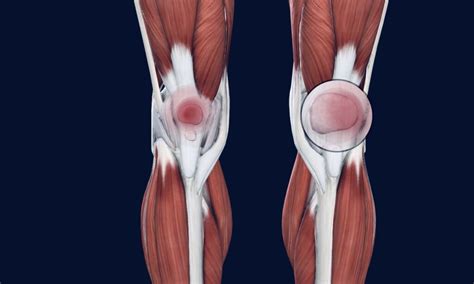 Runner`s Knee Archives Osteo Health Osteopath Clinic In Calgary