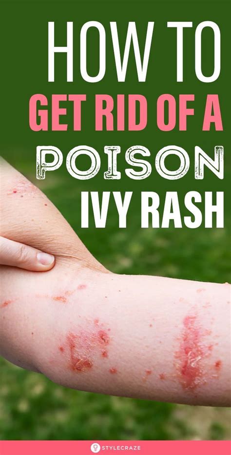 How To Get Rid Of A Poison Ivy Rash Overnight Artofit