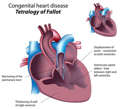 Congenital Heart Disease How It Can Affect Us In Adulthood
