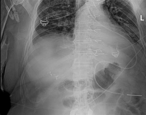Abdominal Radiograph After Dobhoff Tube Placement It Shows A Far