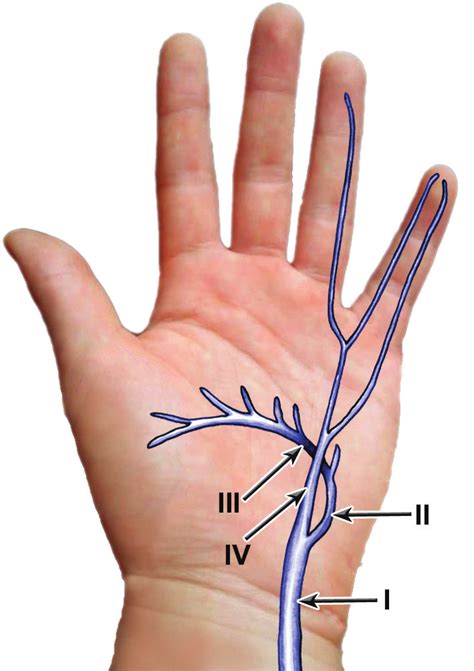 Ulnar Neuropathy Guyon S Canal Ulnar Nerve Neuropathy Hand Therapy My