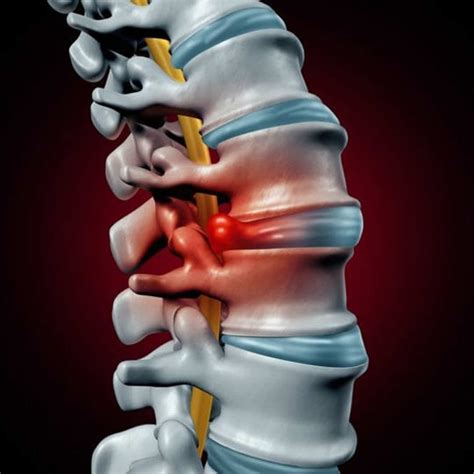 Herniated Disk Causes Symptoms Exercises Surgery Treatment