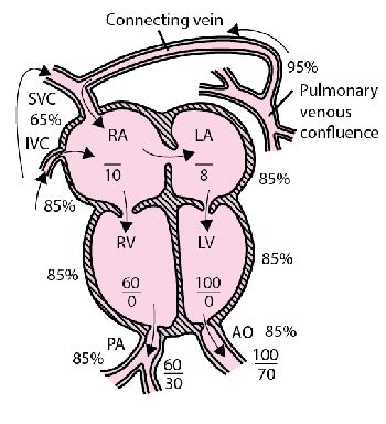 In tapvr, there is a problem in the normal connection between the blood vessels coming from the lungs to the left atrium. Total Anomalous Pulmonary Venous Return (TAPVR ...