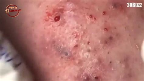 ️ top 10 blackheads removal satisfying video youtube