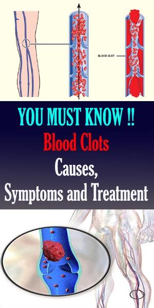 Blood Clots Causes Symptoms And Treatment Healthy Lifestyle