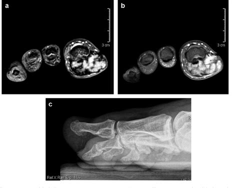 Figure From Localized And Diffuse Forms Of Tenosynovial Giant Cell