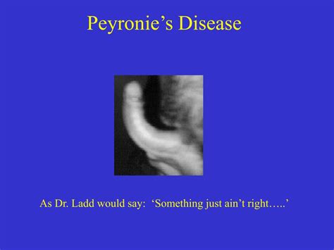 Peyronie Disease Images
