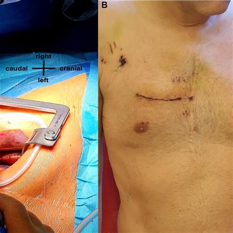 A Right Anterior Mini Thoracotomy Through A 5 Cm Skin Incision At The