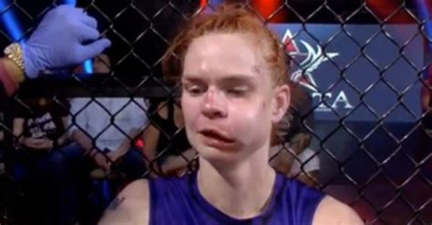 Peggy Morgan Gives Photo Update Days After Horrific Fight Injury BJPenn Com