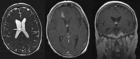 Dieses verfahren nennt man auch mechanische thrombektomie. Klinik und Poliklinik fuer Neurochirurgie: Hydrocephalus
