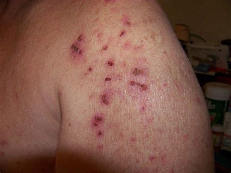 Stages Of Morgellonsfav Event Invitations