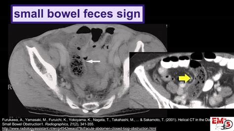 Ct Imaging Small Bowel Obstruction Sbo Youtube