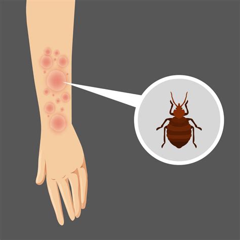 How To Treat Allergic Reaction To Bed Bug Bites Bed Western