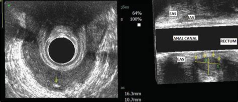 The Role Of Three Dimensional Endoanal Ultrasound In Preoperative Evaluation Of Anorectal