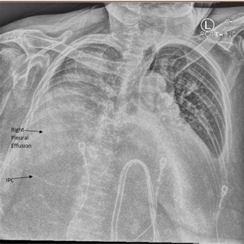 Chest X Ray Anteroposterior View Revealing Bilateral Pleural Effusions
