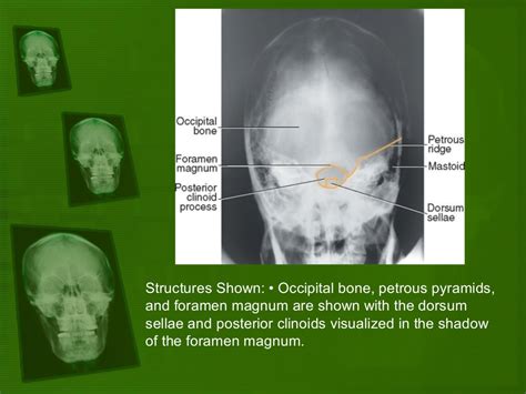 Positioning And Radiographic Anatomy Of The Skull