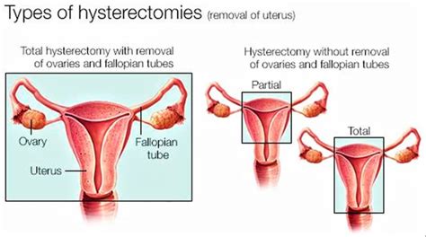 Hysterectomy Reasons Types Of Hysterectomy Hysterectomy Side Effects
