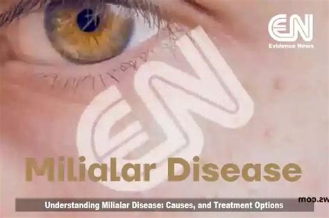 Understanding Milialar Disease Causes And Treatment Options