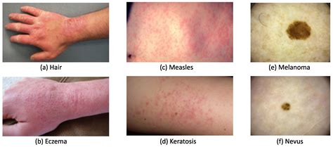 Processes Free Full Text Machine Learning Methods In Skin Disease